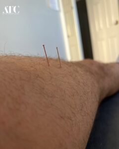 dry needling